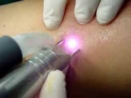 17 Tratamiento laser percutaneo telangiectasias
