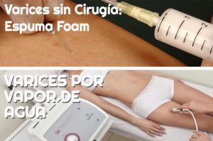 varices sin cirugia
