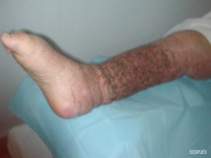 Tratamietno de Elefantasis en Málaga