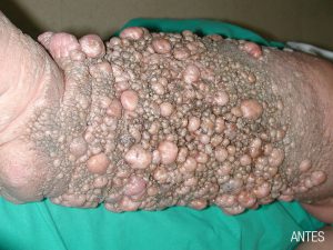 Tratamietno de Elefantasis en Málaga