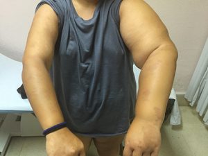 Linfedema_postmastectomia_60