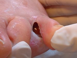 Úlcera interdigital en pie diabetico