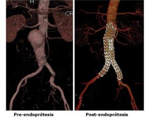 exclusión endovascular