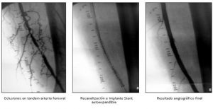 Oclusiones en tandem