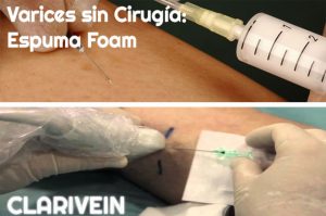 Tratamiento Varices en Málaga
