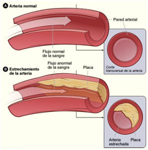 trombosis arterial