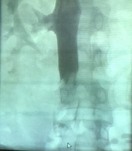 Trombosis de Vena Cava