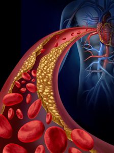 Arteriosclerosis
