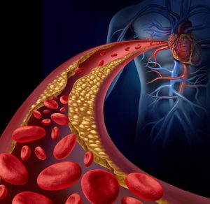 Arteriosclerosis