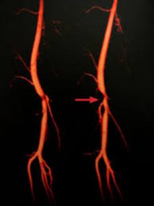 Estenosis de arteria femoral superficial