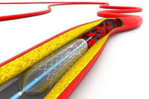 Angioplastia Stent