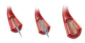 Implante de Stent