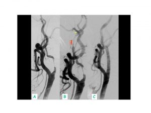 Stent en carotida interna